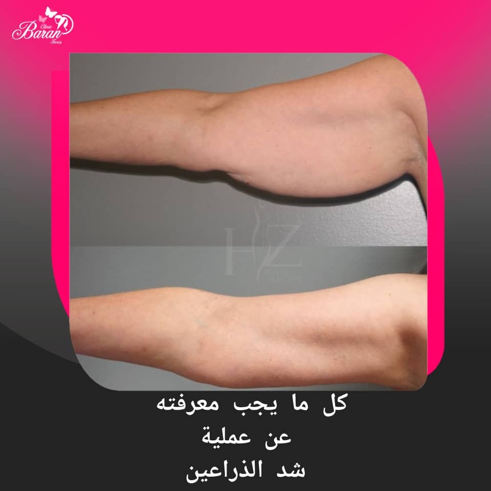 عملية شدّ الذراعين: الدليل المتكامل للتخلّص من ترهّل الذراعين واستعادة تناسق الجسم